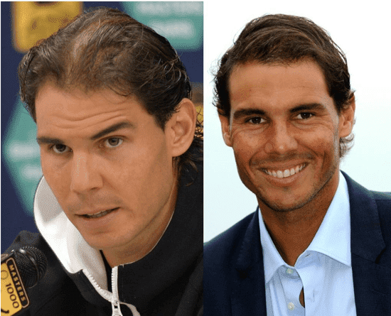Combien a coûté la greffe de cheveux de Rafael Nadal ?
