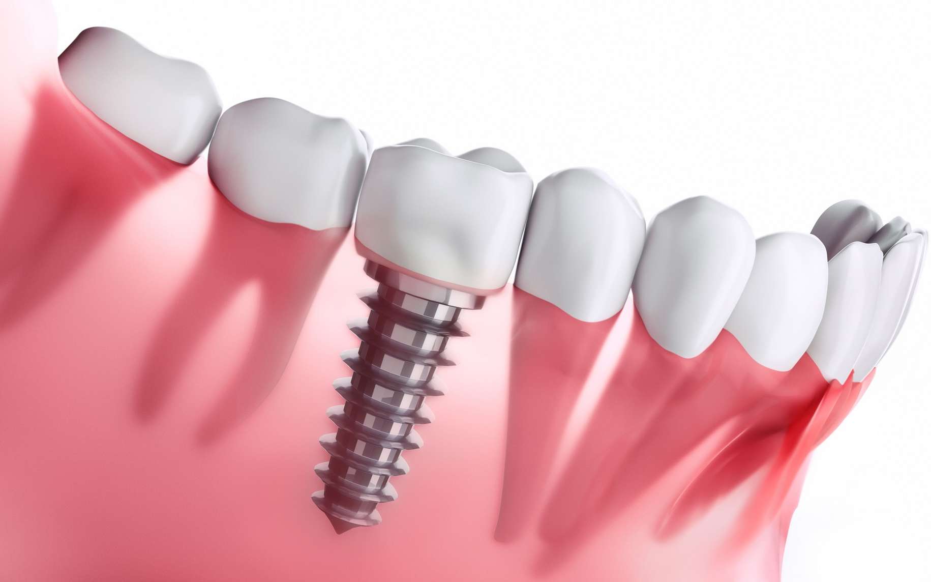 Quel est le prix de la pose d’implant dentaire en Tunisie ?